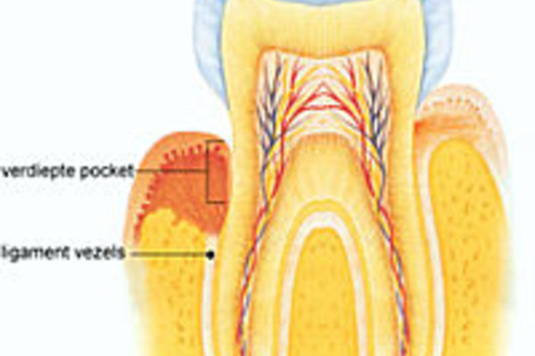 parodontitis2.jpg 