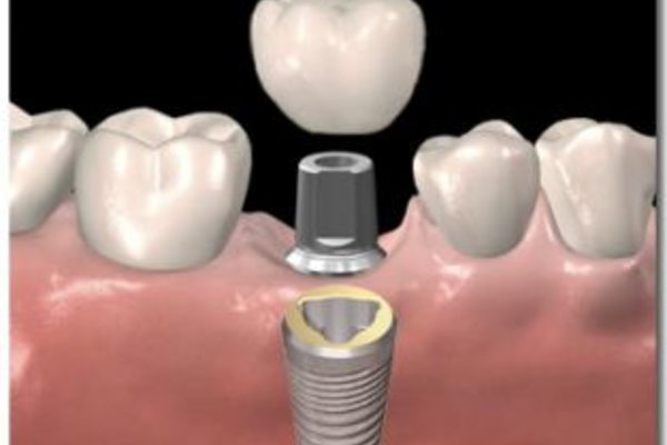 implantaat-dank aan kliniek voor tandheelkunde utrecht.jpeg